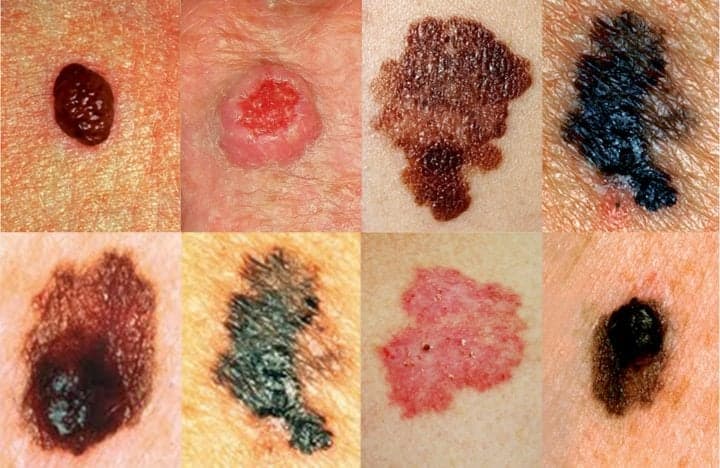 Меланома кожи: лечение и диагностика – Киев – Симптомы