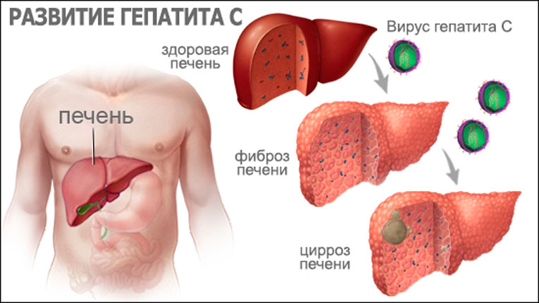 Гепатит С (Ц). Как выявить - необходимые анализы. Симптомы - как  проявляется гепатит С - «ГЕПАТИТ.РУ»