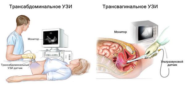 Диспареуния: причины, симптомы и лечение в статье гинеколога Соловьева Т. С.